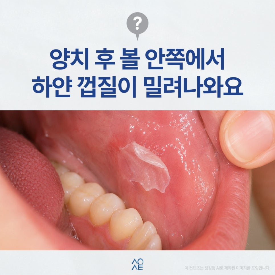 구강점막 벗겨짐 이유 치약 때문이려나요 하얀 껍질이 생긴다면 관련 이미지 1