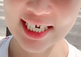 잠원동치과 무삭제 라미네이트 기간 앞니 깨짐 관련 이미지 7