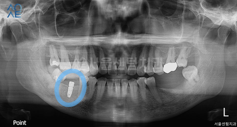 치아상실 후 임플란트 하려면 관련 이미지 2