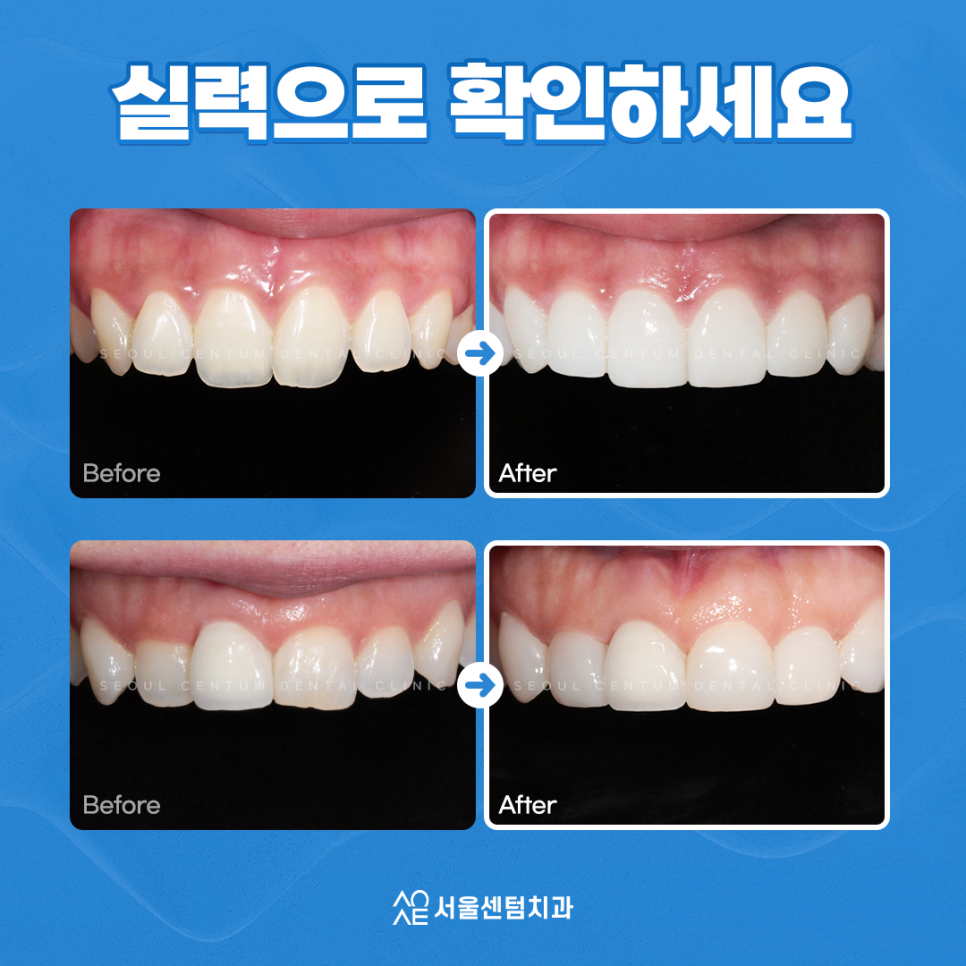 무삭제 라미네이트 안되는 분들도 많습니다. 관련 이미지 6