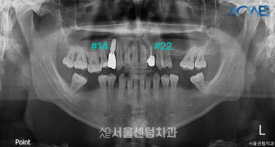 Here’s How a Korean-Made Implant Is Actually Placed image 6