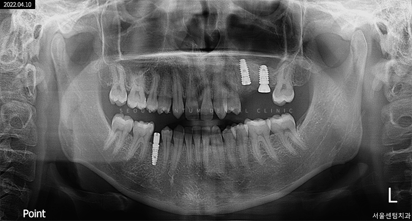 임플란트2차수술과정 언제 필요한지 핵심만 짚어보기 관련 이미지 4