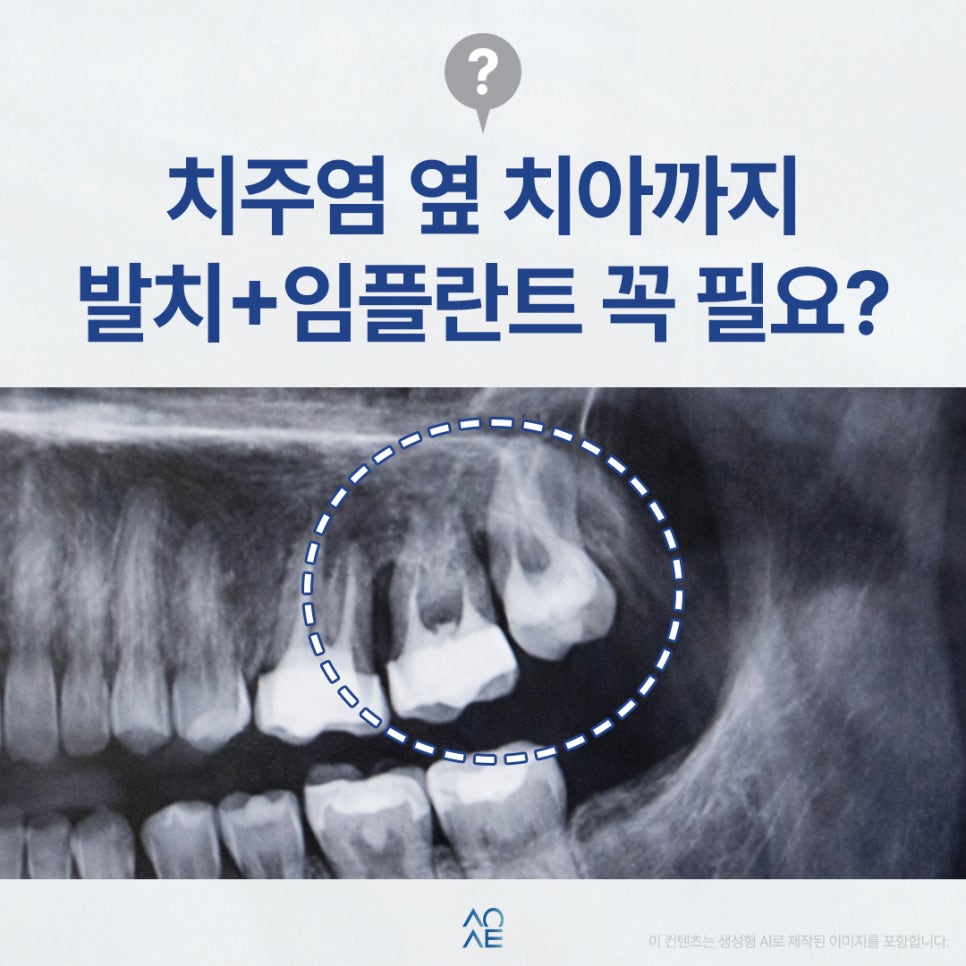 임플란트 치주염 옆자리에 권유받았다면 필요한지 판단할 것 관련 이미지 1