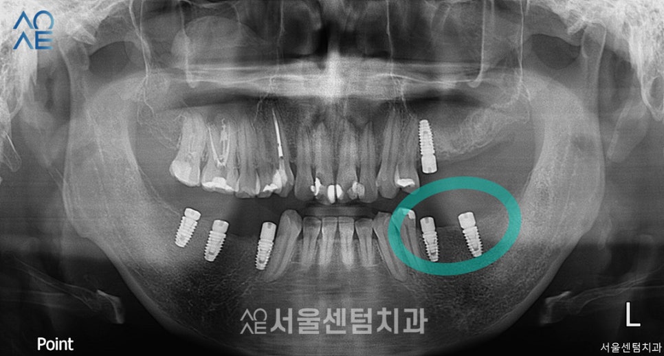 30대임플란트 치아상태 좋지 않아도 안심 관련 이미지 4