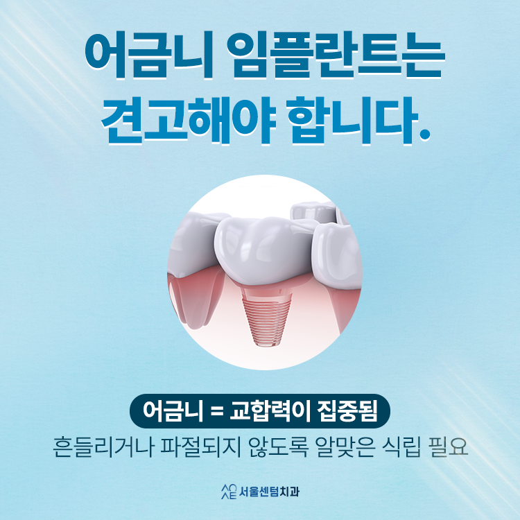 어금니 임플란트 앞니보다 신중해야 한다? 숨은 진실 관련 이미지 3
