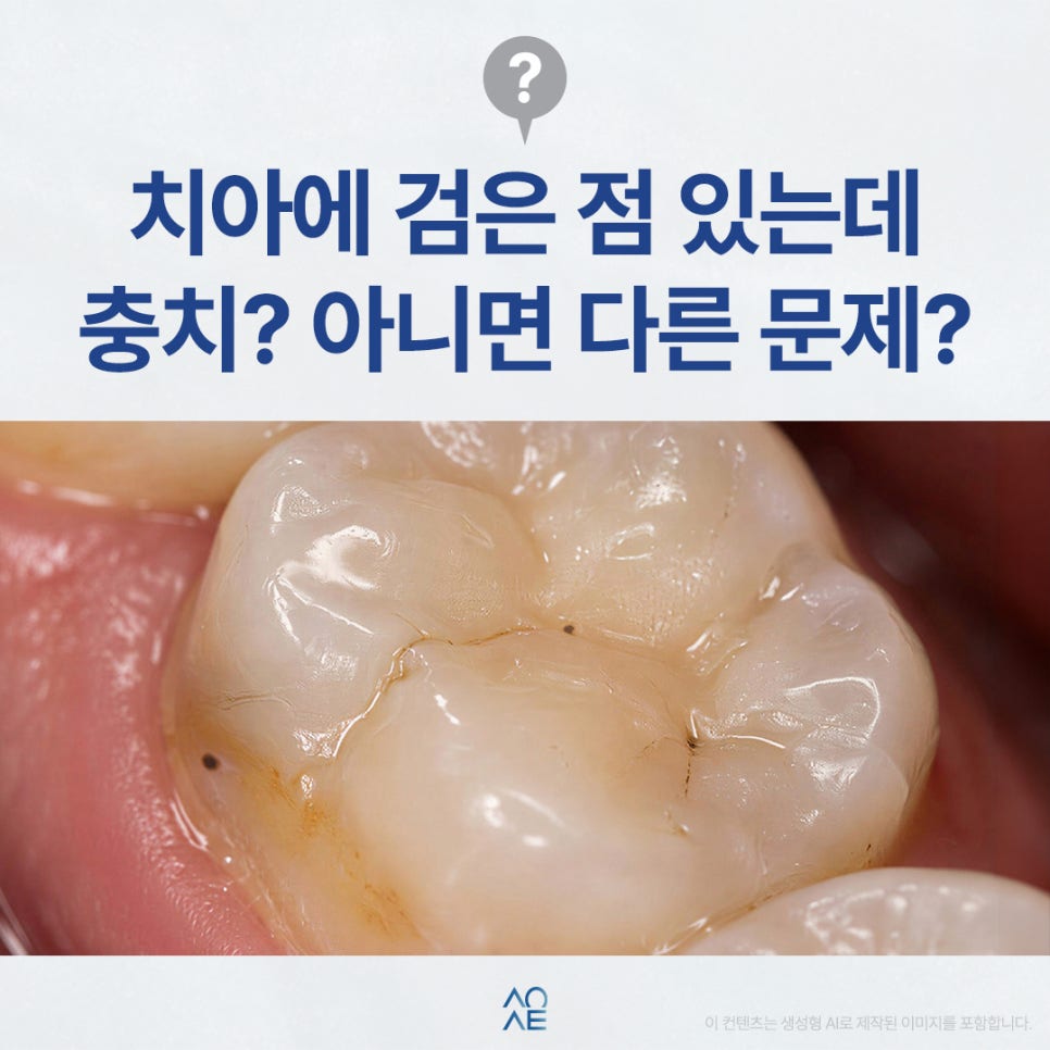 치아 검은점 발견했다면 충치인지 다른 문제인지 구분 방법 관련 이미지 1