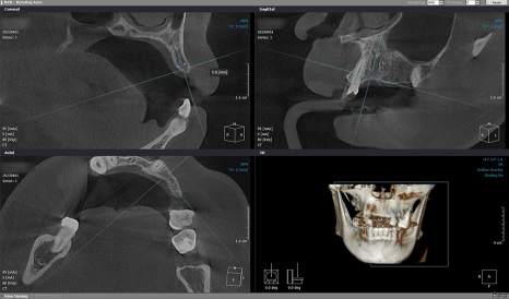 임플란트 브릿지와 크라운 수복으로 치아 기능을 회복시킨 증례 관련 이미지 4