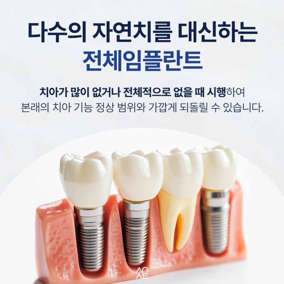 전체임플란트 가격 발품 시 악당 전악 뜻 모르면 헷갈릴 수 있습니다 관련 이미지 3
