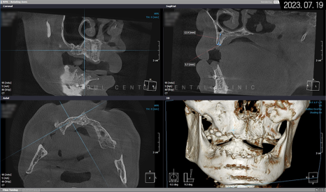 전체임플란트 기간 예상보다 줄어들 수 있는 방법과 증례 공개 관련 이미지 8