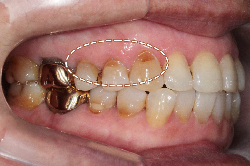 치경부마모증 가격 gi 레진 갈색치아 원인 통증 관련 이미지 11