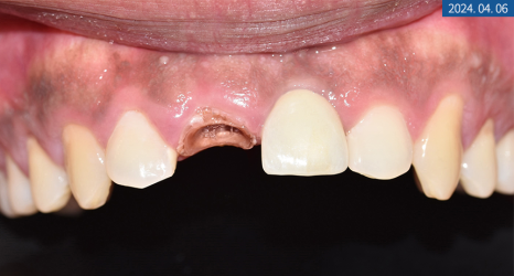 앞니 임플란트 식립으로 저작 기능을 끌어올린 증례 관련 이미지 7