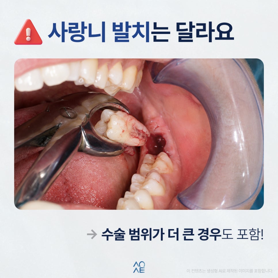 How Many Days Should I Avoid Alcohol After a Tooth Extraction? image 3