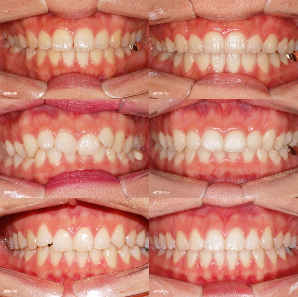 치아교정 잇몸 퇴축 왜 발생하고 어떻게 막을 수 있을까 관련 이미지 6