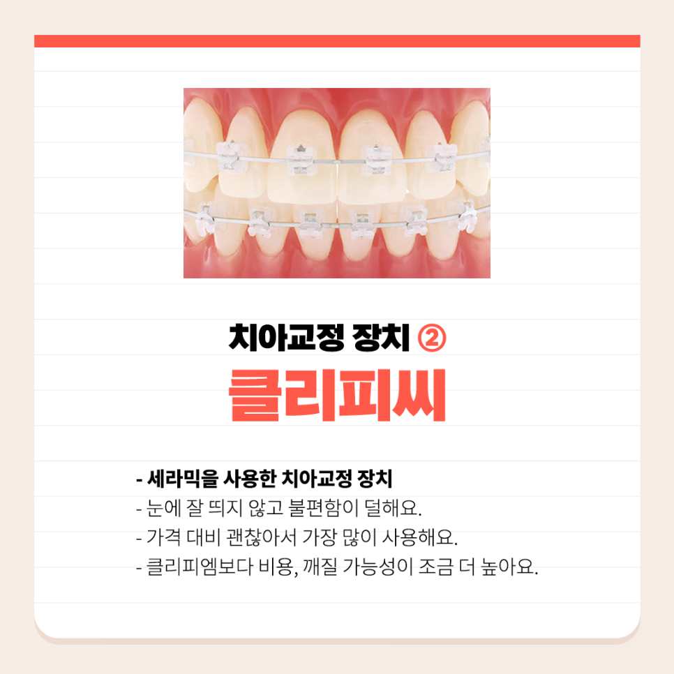 치아교정장치 종류 하나하나 알려드려요 관련 이미지 3