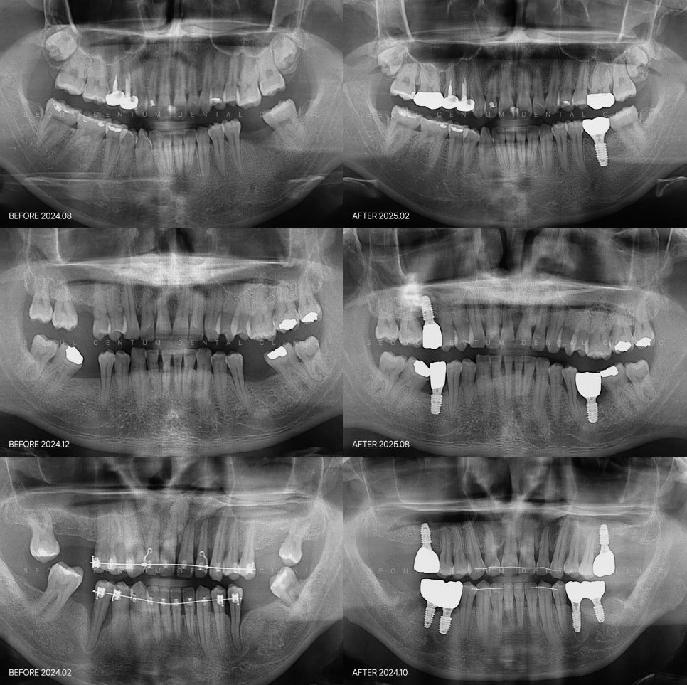 임플란트하고 통증 기간 언제까지? 무조건 참는 게 답일까 관련 이미지 6