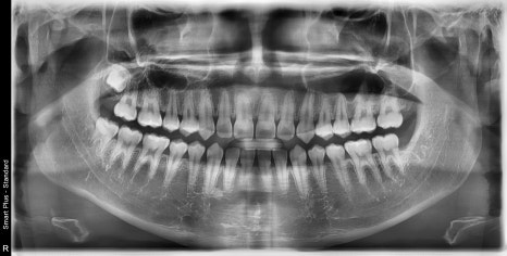 신사역 매복 사랑니 4개 발치 꼭 해야하나요? 관련 이미지 12