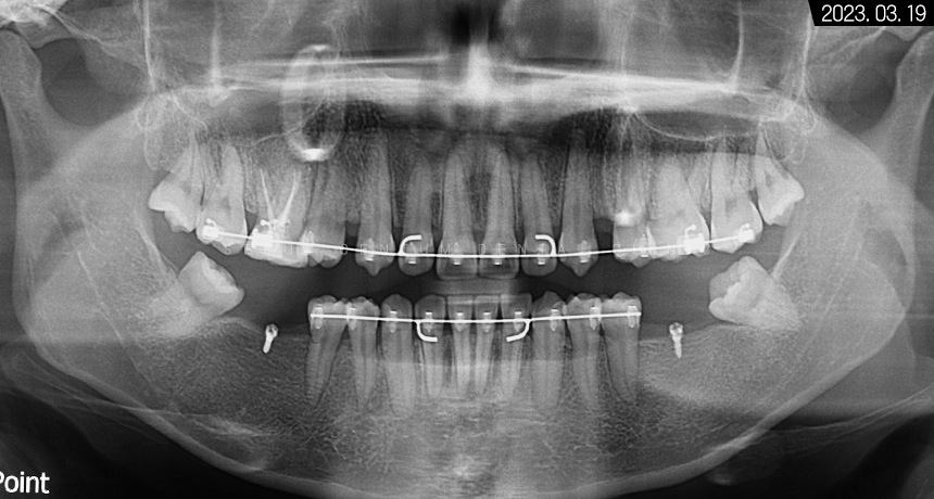 돌출입 및 신경치료와 임플란트 식립 동시 진행 증례 관련 이미지 15