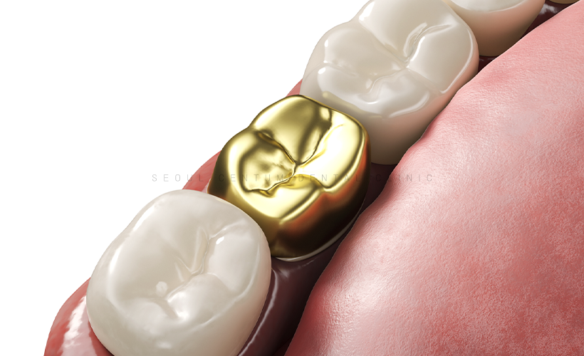 임플란트 크라운 종류 토요일과 일요일도 여는 치과에서 안내! 관련 이미지 4