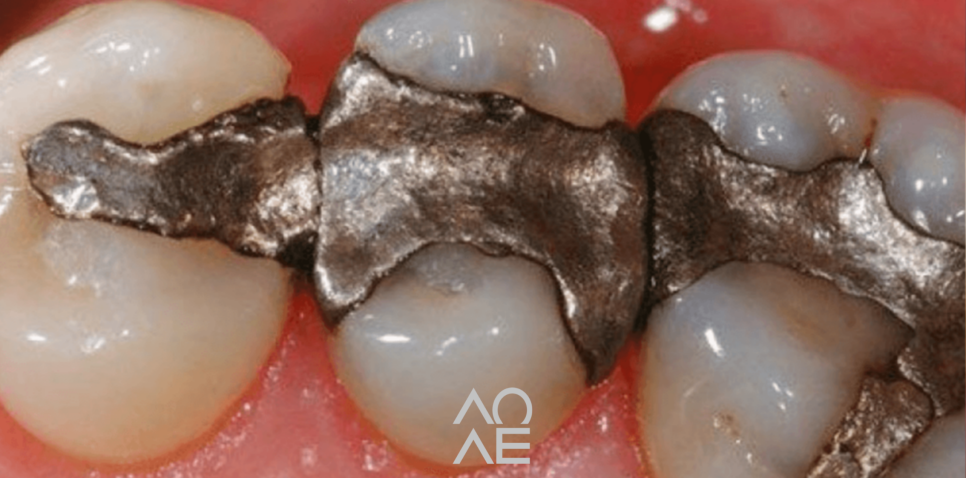 강남양심치과에서 오래된 아말감 교체하세요! 관련 이미지 3