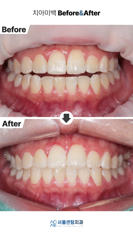 치과치아미백 전후 사진과 종류 소개 관련 이미지 6