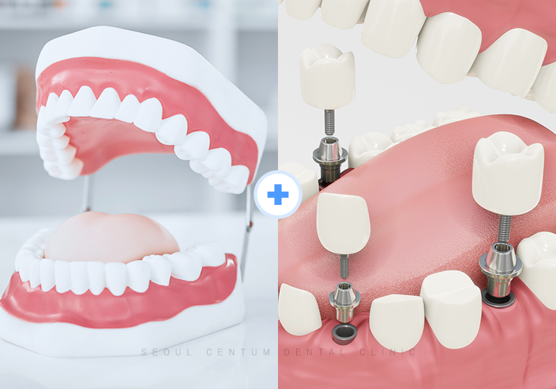 틀니임플란트 주의사항 알면 장점을 더 누릴 수 있어요 관련 이미지 4