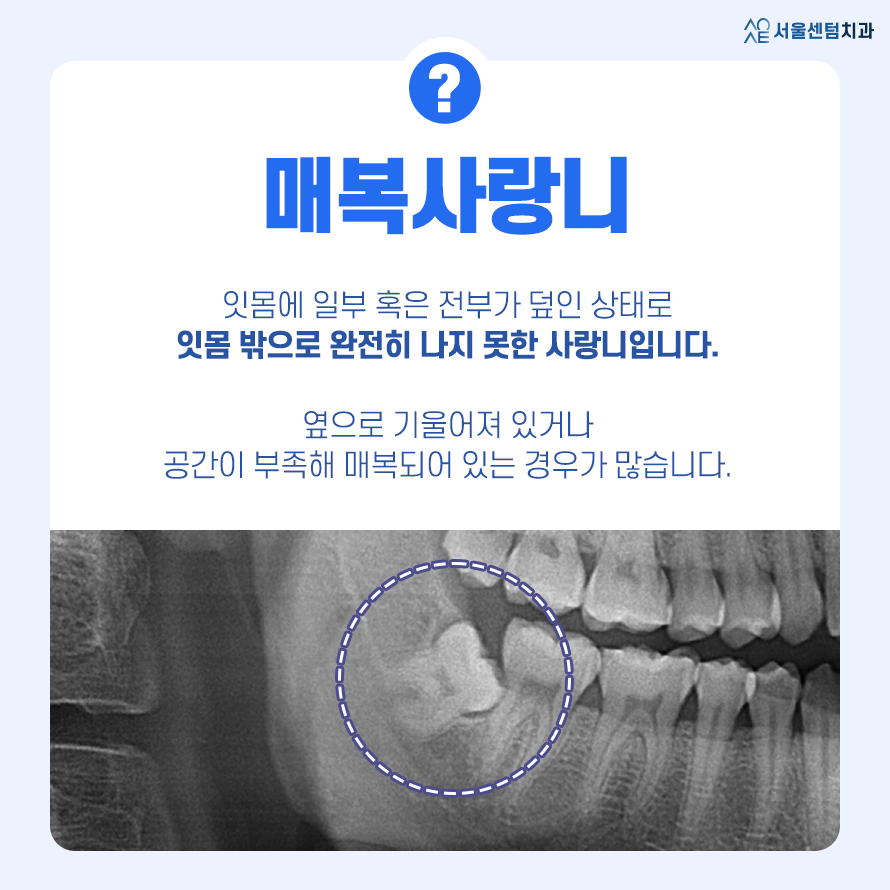 매복사랑니 발치통증 얼마나 지속될까? 관련 이미지 2