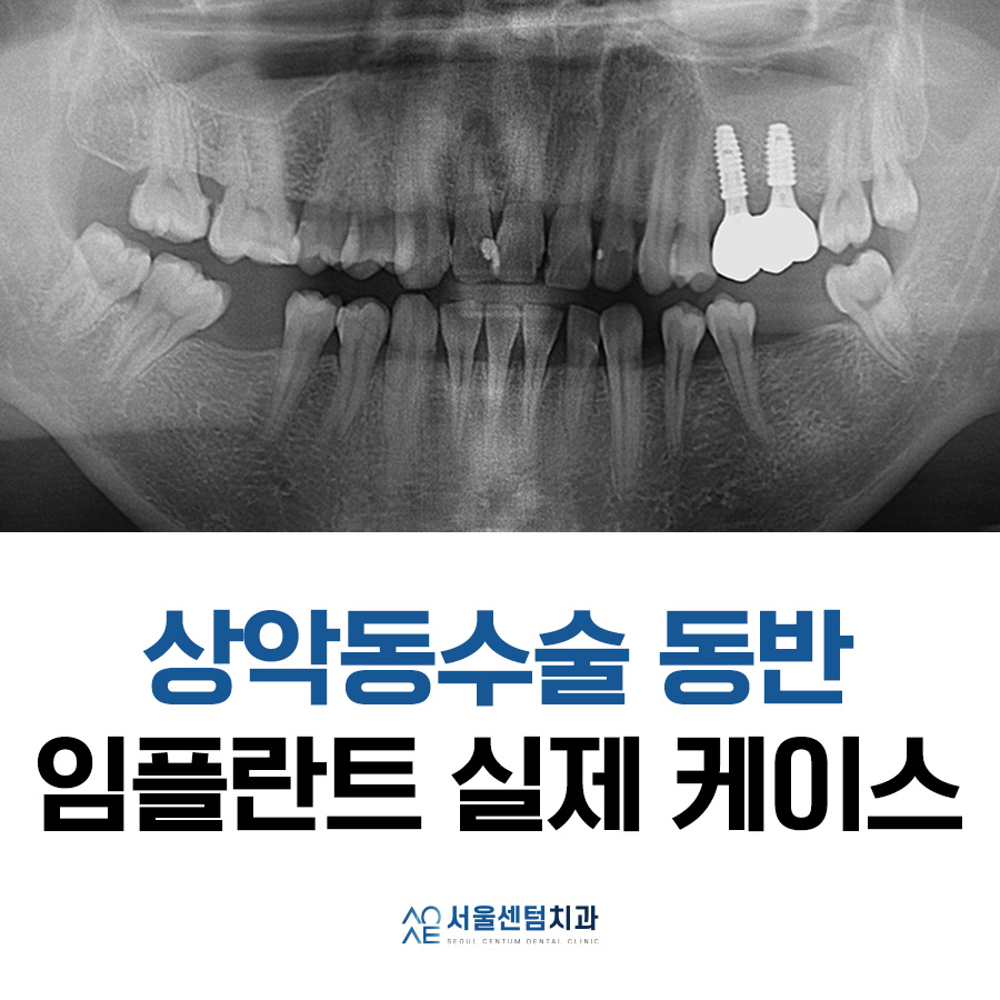 상악동수술 동반한 임플란트 진행한 이야기 관련 이미지 7