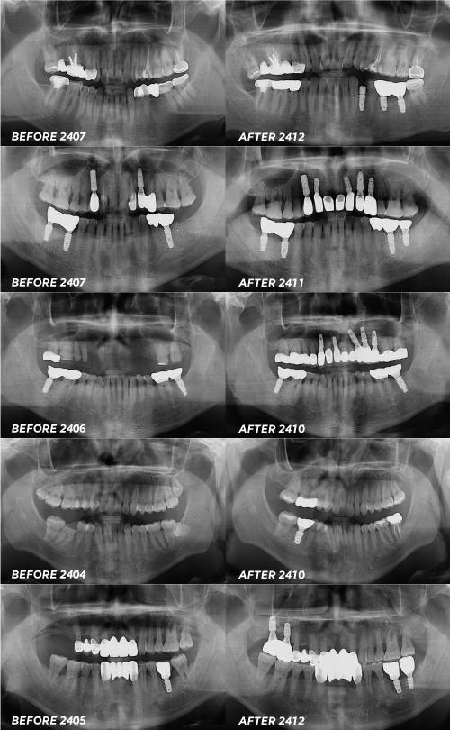 임플란트 치약 아무거나 사용해도 괜찮을까 임플란트 관리 전용치약 있나요 관련 이미지 9