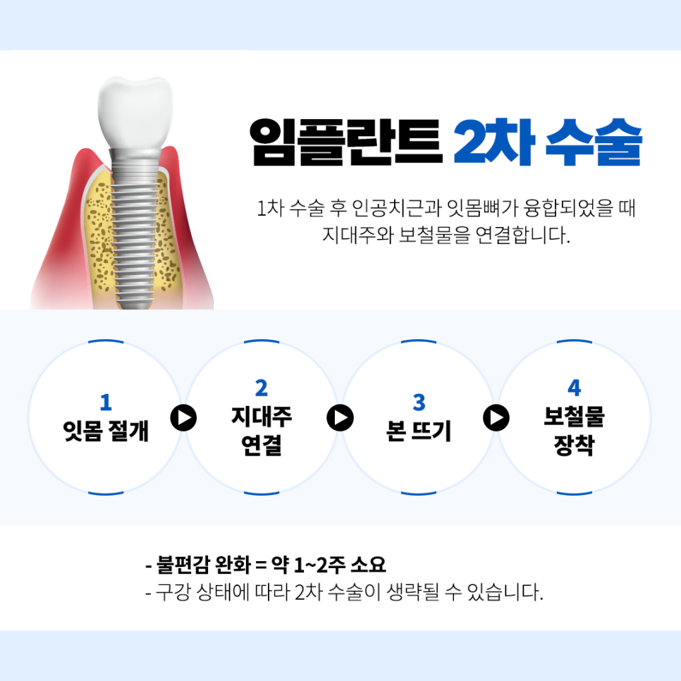 임플란트수술 기간 이거 하나로 정리 끝 관련 이미지 3