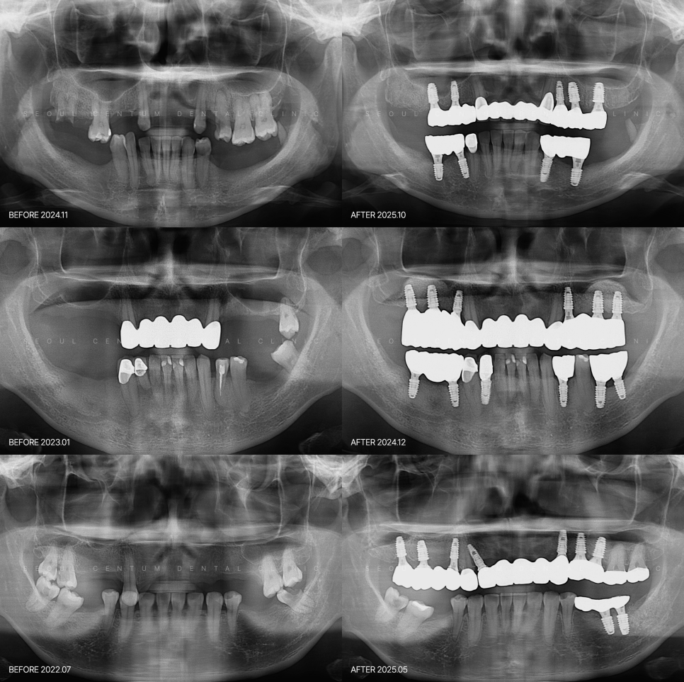 전체임플란트 비용 기준 삼는 사항을 바탕으로 결정된다? 관련 이미지 6