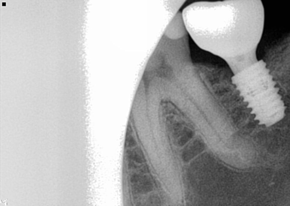 신사역치과 발치후 임플란트 시술과정 30대 남성 케이스 관련 이미지 10