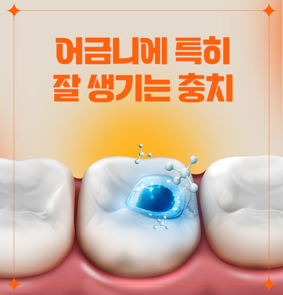 매일 양치해도 충치 생기는 이유 관련 이미지 3