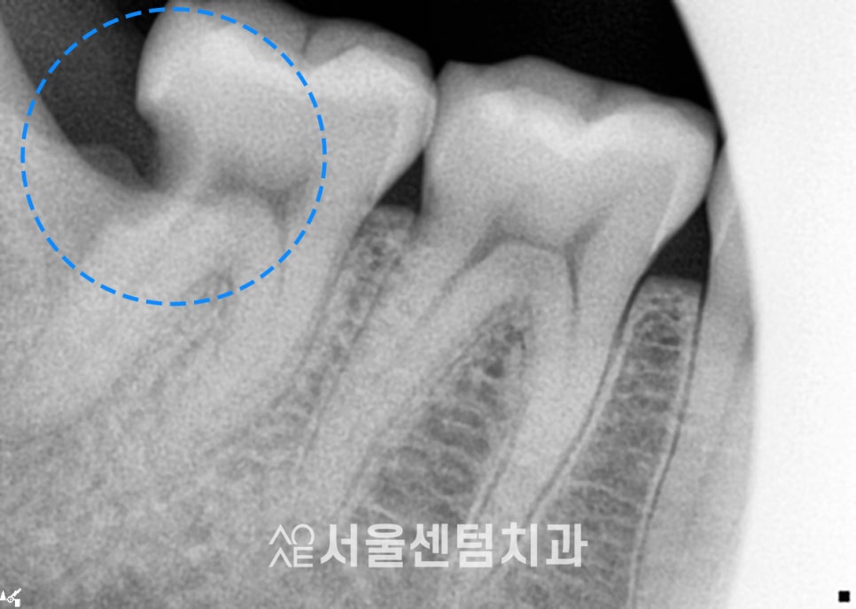 A Successful Molar Implant Case in a Patient in Their 20s image 4