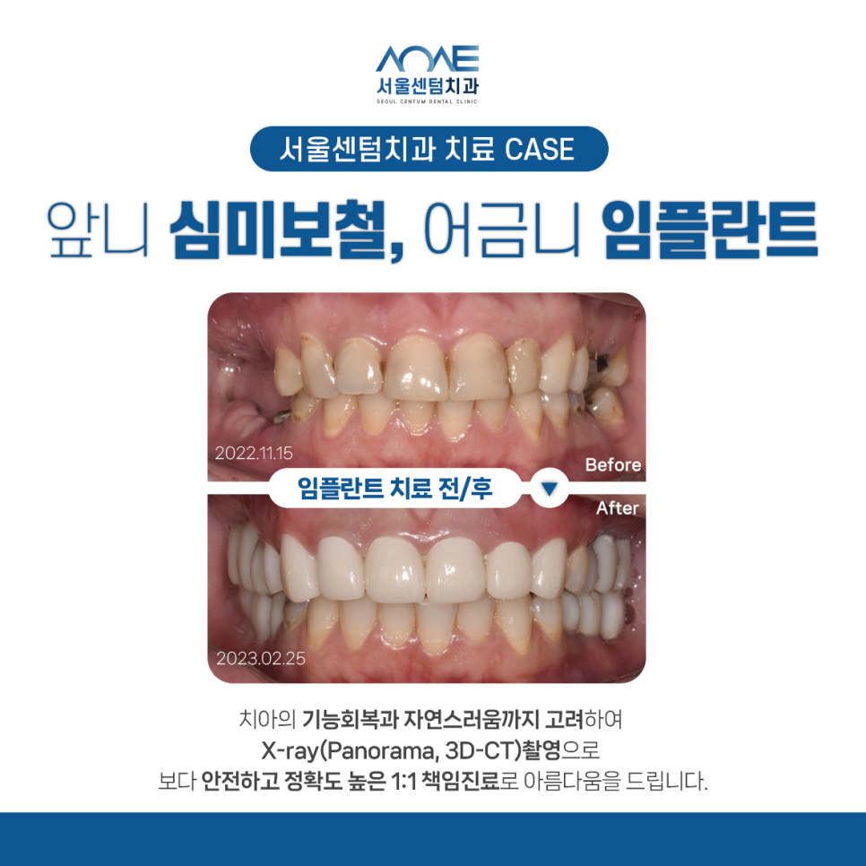 치과 마취 종류 풀리는 시간 주의사항에 대해서 관련 이미지 11