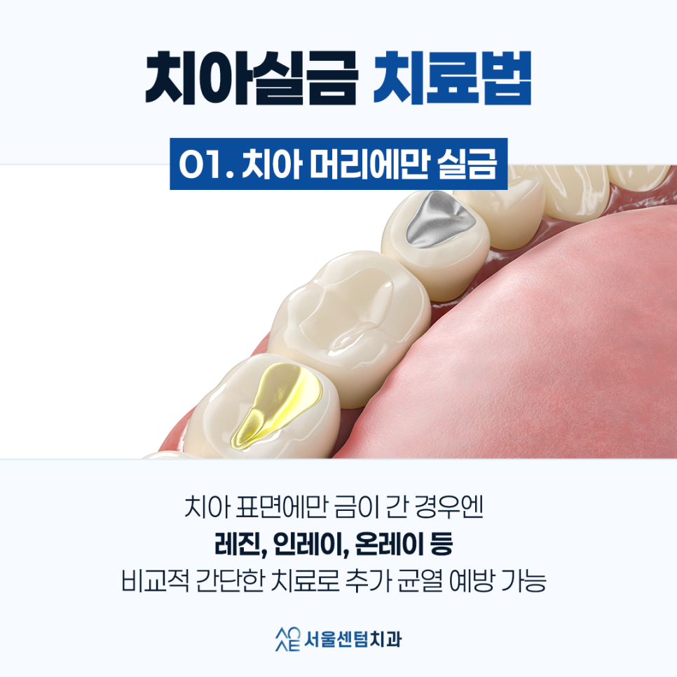 치아실금 신경쓰인다면 이것 체크하세요 관련 이미지 4