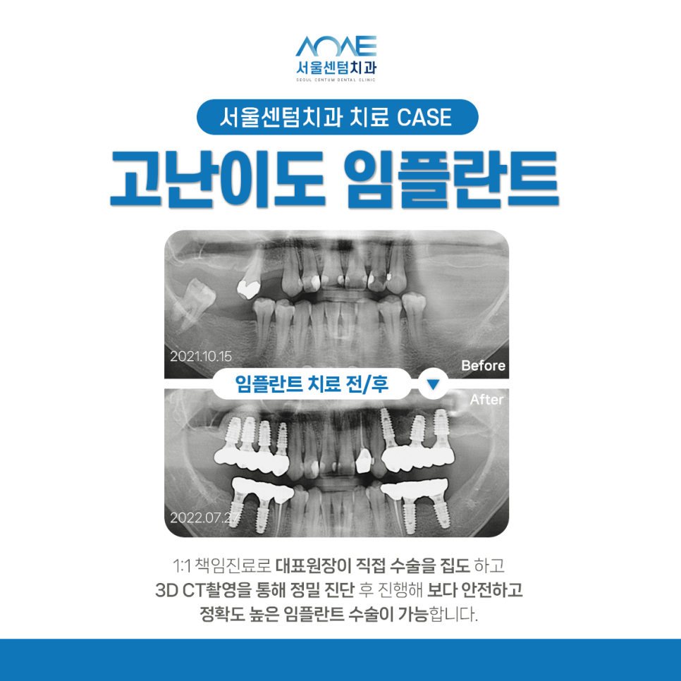 잠원임플란트 노인틀니 비용 보험 가능 조건은? 관련 이미지 6