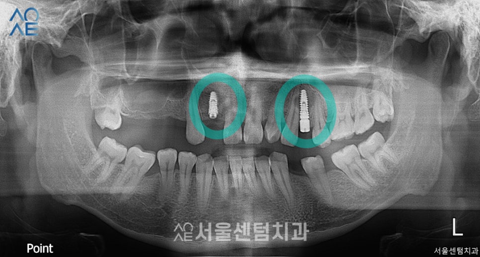 임플란트 과정 기간 실제 사례로 설명드려요 관련 이미지 2