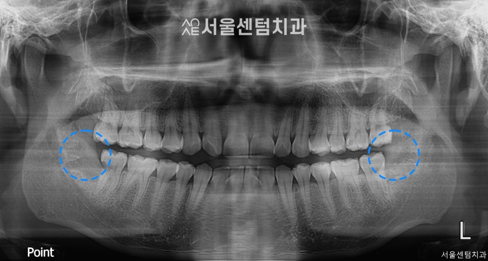 A Successful Molar Implant Case in a Patient in Their 20s image 5