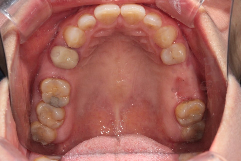 40대 임플란트 치료 케이스 상악동거상술 골이식까지 관련 이미지 1