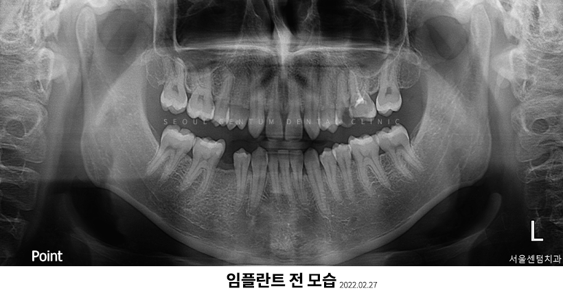 임플란트2차수술과정 언제 필요한지 핵심만 짚어보기 관련 이미지 1