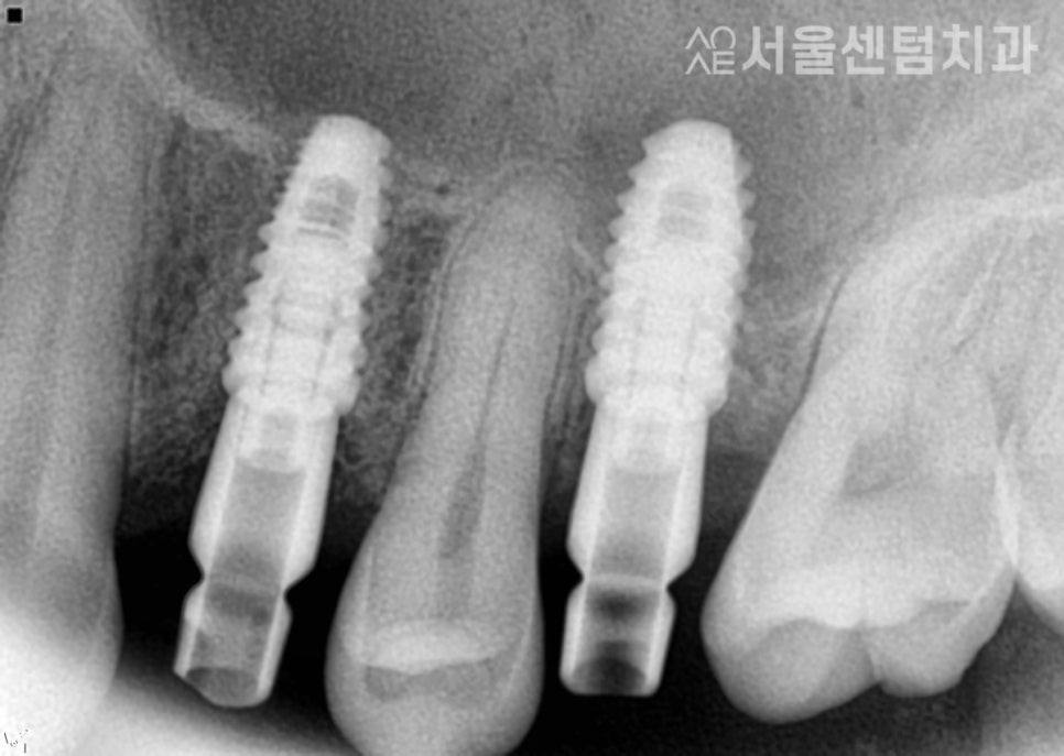 앞니 임플란트기간 실제 수술사례로 알려드려요 관련 이미지 3