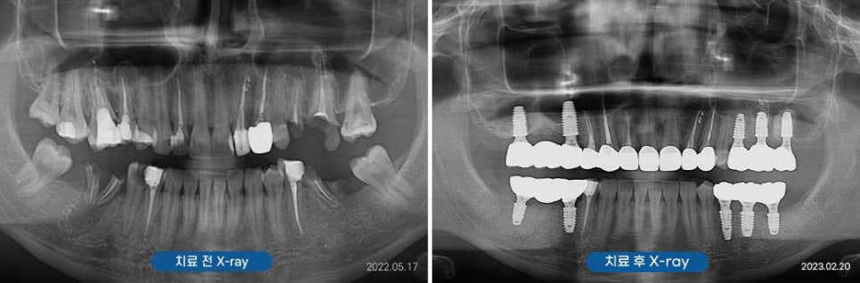 신사역주말치과 갑자기 어금니 이빨 부러졌다면 관련 이미지 9