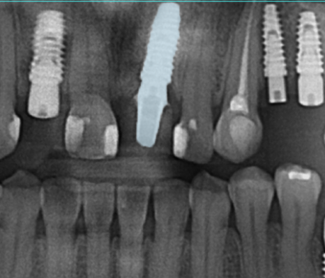 잠원역치과 임플란트 보험 실비 가능하나요? 관련 이미지 12
