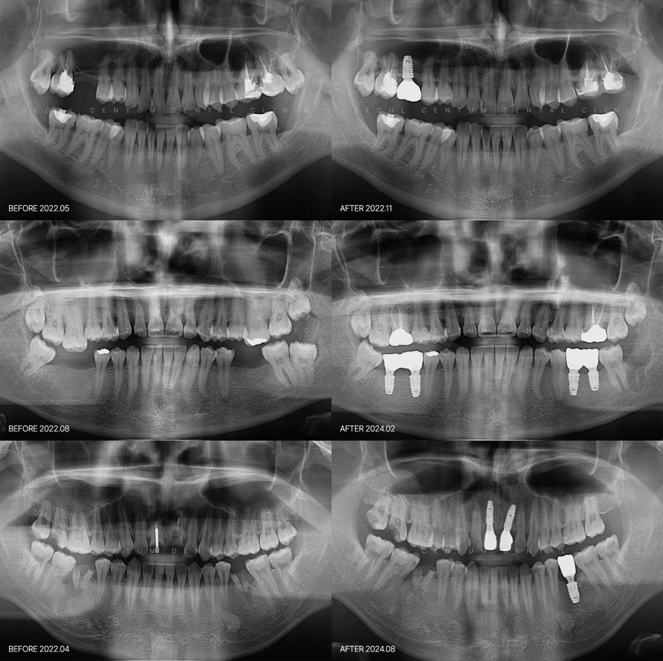 임플란트 구조 하나하나 뜯어보면 알 수 있는 원리 관련 이미지 6