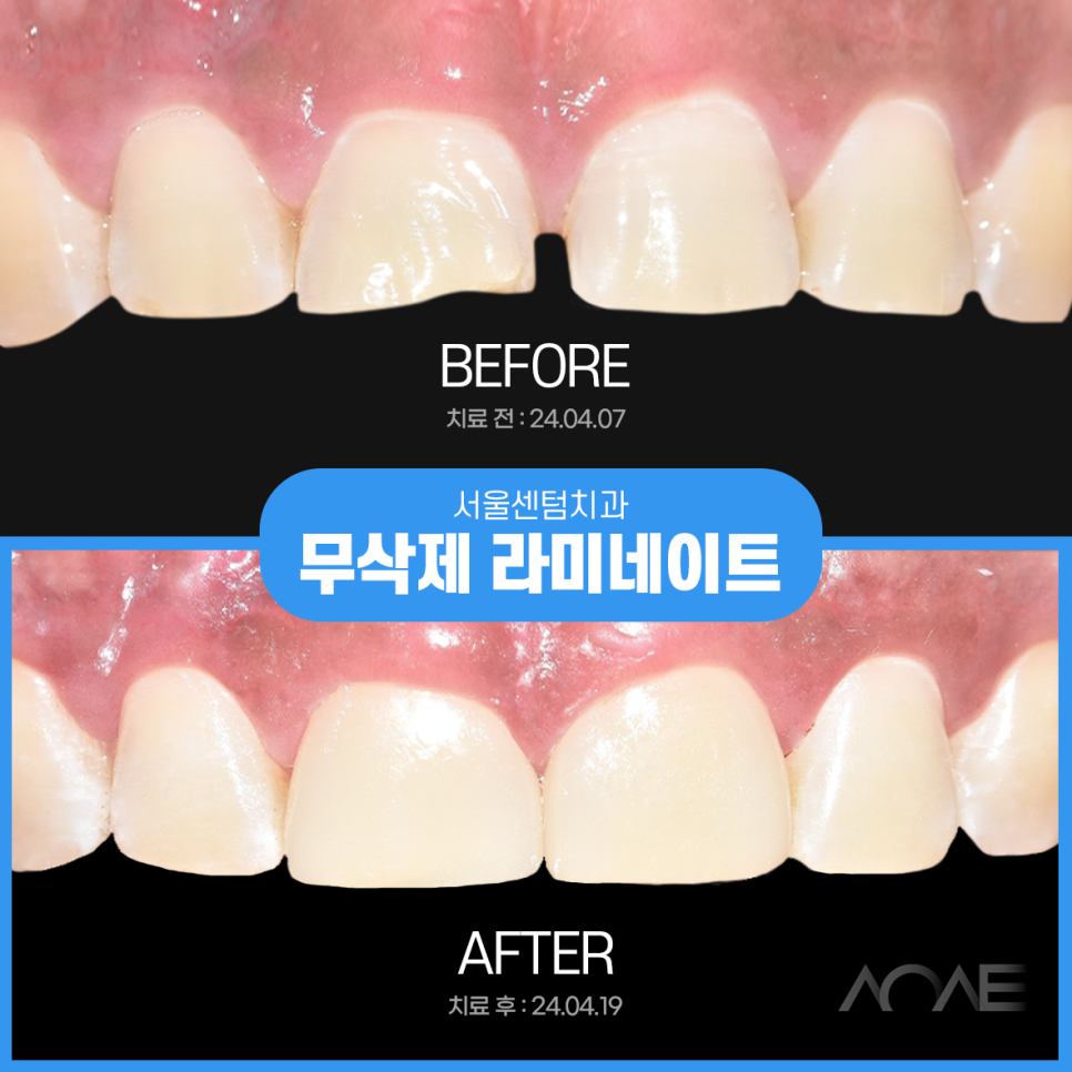잠원동치과 무삭제 라미네이트 기간 앞니 깨짐 관련 이미지 10