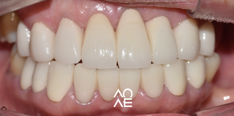 잠원동 교정 반대교합 크라운 치료도 가능합니다. 관련 이미지 13