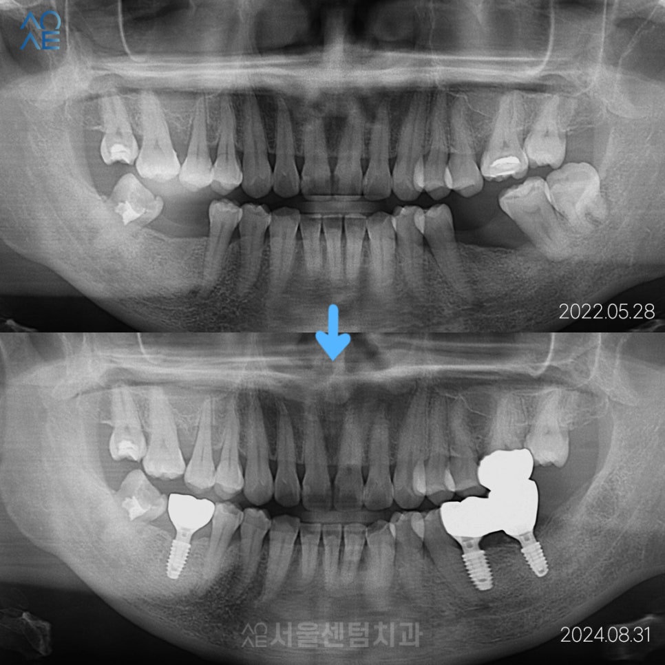 치아상실 후 임플란트 하려면 관련 이미지 5
