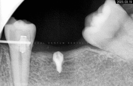 돌출입 및 신경치료와 임플란트 식립 동시 진행 증례 관련 이미지 13