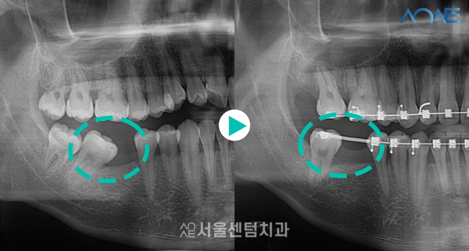 교정임플란트 모두 맡겨주신 결과 관련 이미지 3