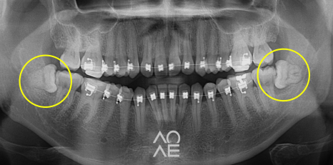 사랑니 발치 통증 붓기 줄이는 법 관련 이미지 7